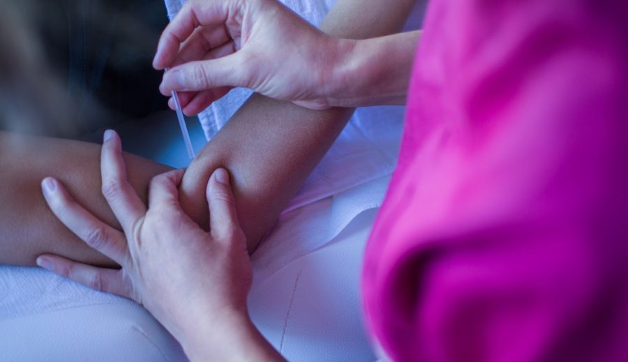 Punción seca; es una técnica semi-invasiva que utiliza agujas de acupuntura para el tratamiento del síndrome de dolor miofascial, síndrome producido por los puntos de gatillo, con el fin de desactivar el punto y disminuir el dolor.